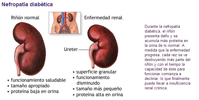 medicina renal para la diabetes medicina renal para la diabetes